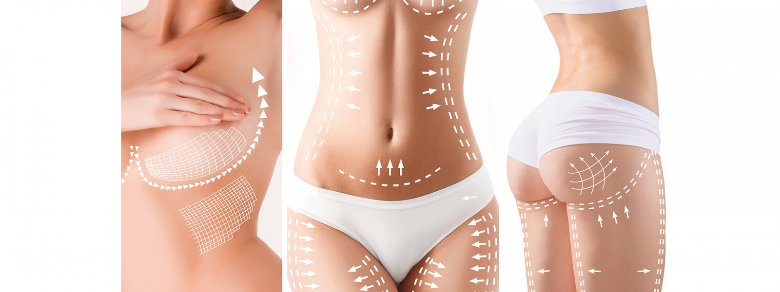 The cellulite removal plan. White markings on young woman body The cellulite removal plan. White markings on young woman body